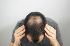 اكتشاف السبب "الدقيق" لتساقط الشعر ما يعد بعلاجات جديدة للصلع